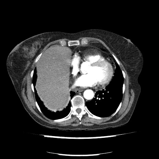 Bladder tumor detected on trauma CT (Radiopaedia 51809-57609 A 61).jpg