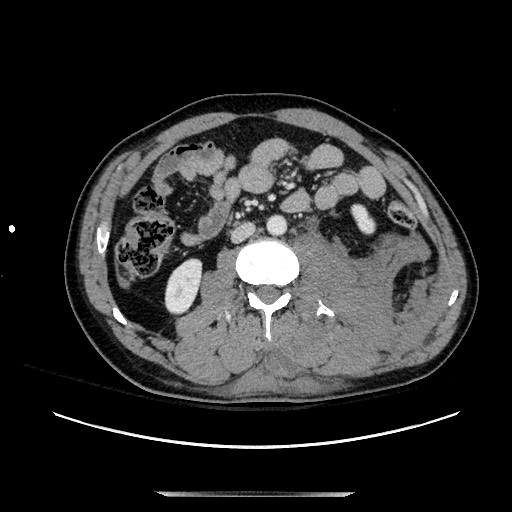 Blunt abdominal trauma with solid organ and musculoskelatal injury with active extravasation (Radiopaedia 68364-77895 A 73).jpg