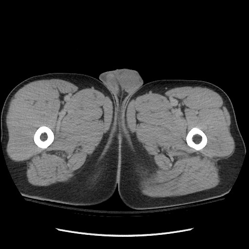 File:Blunt abdominal trauma with solid organ and musculoskelatal injury with active extravasation (Radiopaedia 68364-77895 Axial C+ delayed 163).jpg