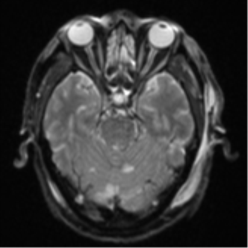 File:Blunt cerebrovascular injury (Radiopaedia 53682-59745 Axial DWI 11).png