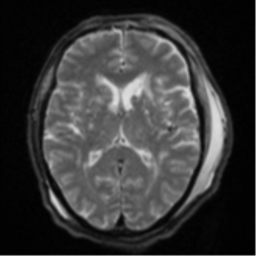 Blunt cerebrovascular injury (Radiopaedia 53682-59745 Axial DWI 17).png