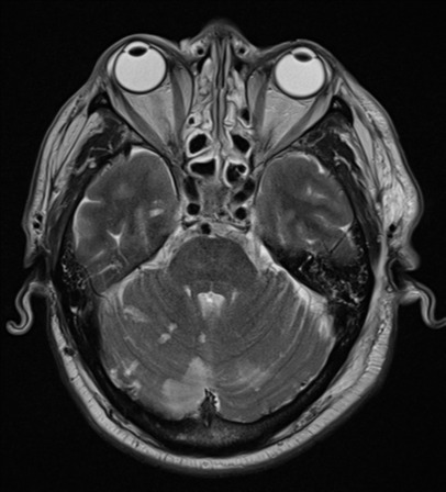 File:Blunt cerebrovascular injury (Radiopaedia 53682-59745 Axial T2 10).png