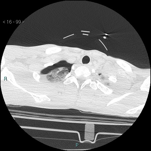 Blunt chest trauma (Swiss cheese sign) (Radiopaedia 38519-40618 Axial lung window 3).jpg