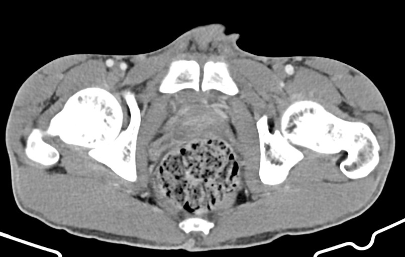 Blunt injury to the small bowel (Radiopaedia 74953-85987 A 191).jpg