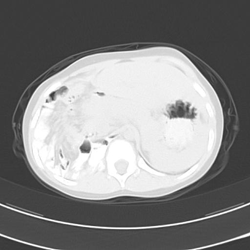 File:Bochdalek diaphragmatic hernia (Radiopaedia 38866-41059 Axial lung window 24).jpg