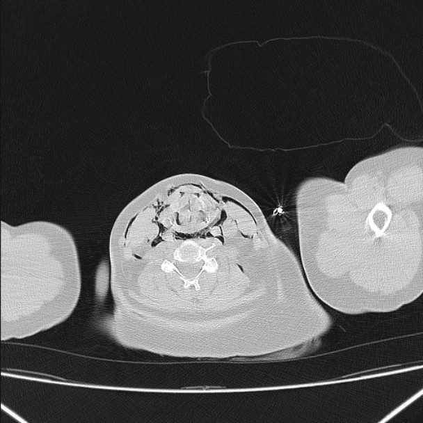 Boerhaave syndrome (Radiopaedia 45644-49799 Axial lung window 10).jpg