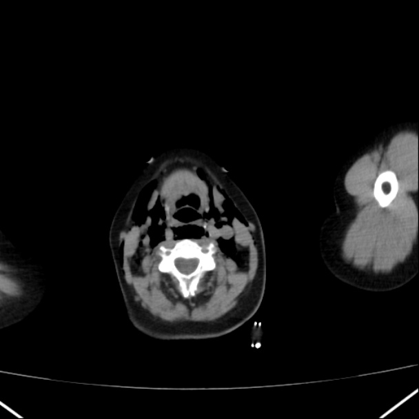 Boerhaave syndrome (Radiopaedia 45644-49799 Axial non-contrast 1).jpg