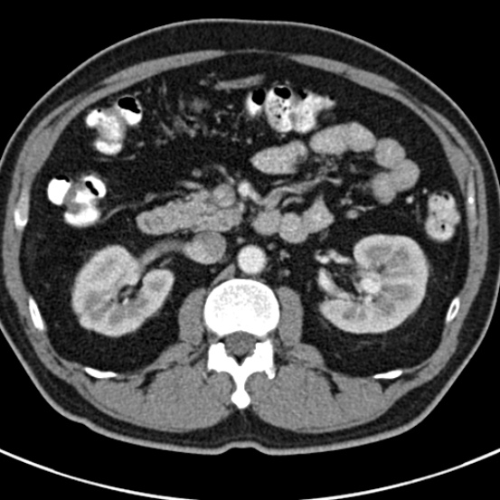 File:Bosniak cyst - type IV (Radiopaedia 23525-23627 renal cortical phase 23).jpg