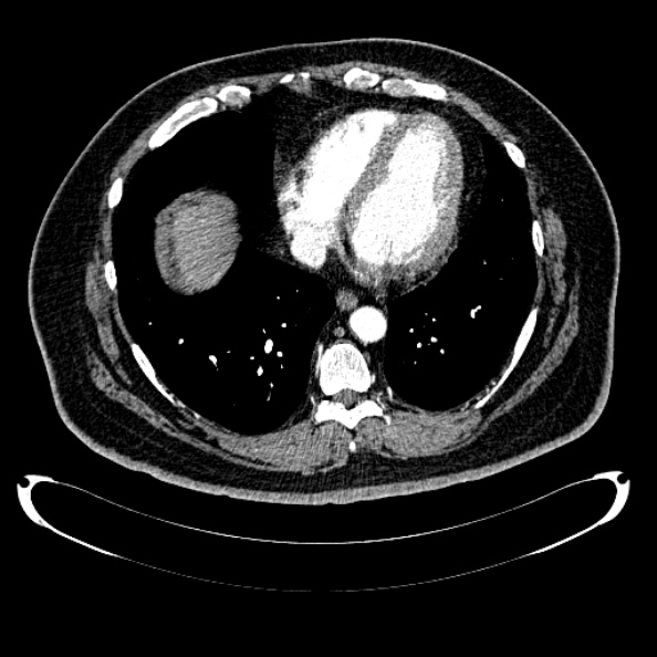 Bosniak renal cyst - type IV (Radiopaedia 24244-24518 B 2).jpg