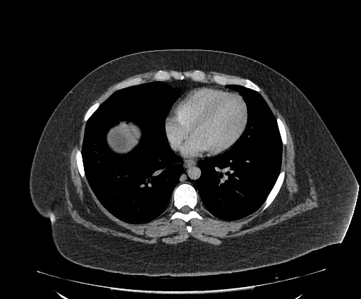 Bowel and splenic infarcts in acute lymphocytic leukemia (Radiopaedia 61055-68913 A 10).jpg
