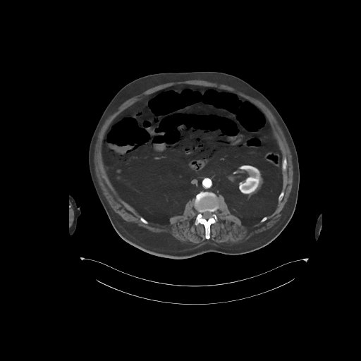File:Bowel ischemia secondary to SMA occlusion with extensive portomesenteric venous gas (Radiopaedia 54656-60871 A 38).jpg