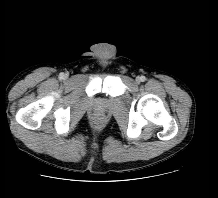 Bowel obstruction from colon carcinoma (Radiopaedia 22995-23028 A 87).jpg