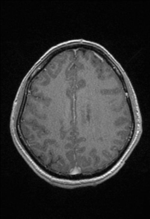Brain abscess with ventriculitis (Radiopaedia 85703-101495 Axial T1 C+ 124).jpg