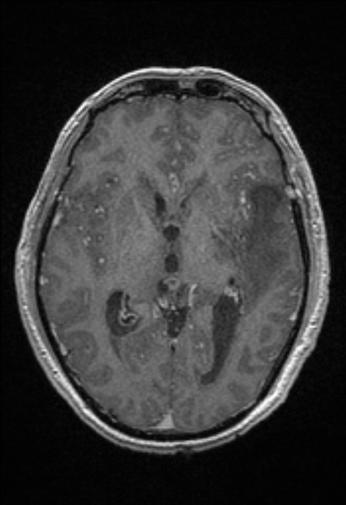 Brain abscess with ventriculitis (Radiopaedia 85703-101495 Axial T1 C+ 89).jpg