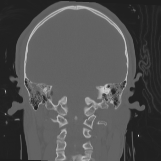 File:Brain contusions, internal carotid artery dissection and base of skull fracture (Radiopaedia 34089-35339 Coronal bone window 44).png