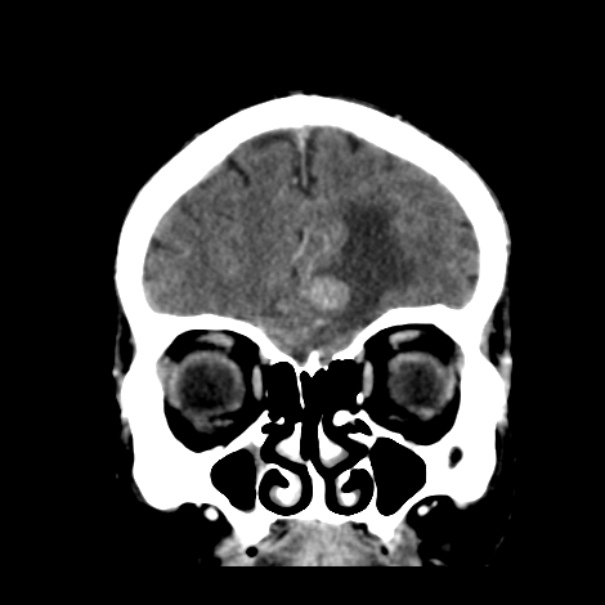 Brain metastases from lung cancer (Radiopaedia 24480-24781 Coronal C+ delayed 13).jpg
