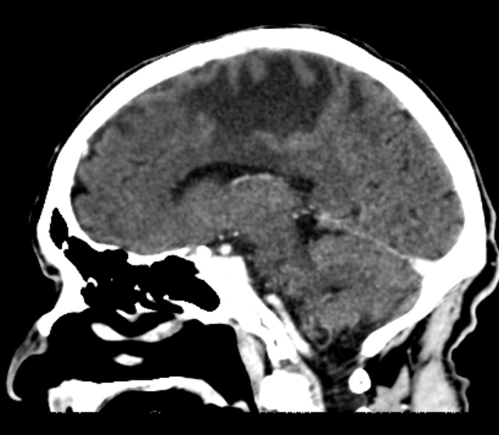 Brain metastases from lung cancer (Radiopaedia 27849-28092 Sagittal C+ delayed 28).jpg
