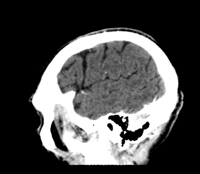 Brain metastases from lung cancer (Radiopaedia 27849-28092 Sagittal C+ delayed 51).jpg