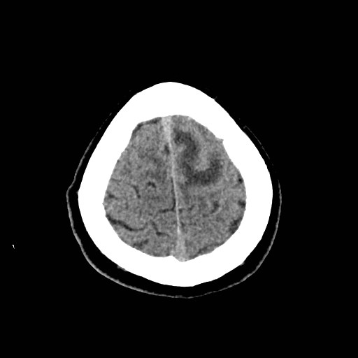 File:Brain metastases from lung cancer (Radiopaedia 83839-99027 Axial non-contrast 32).jpg