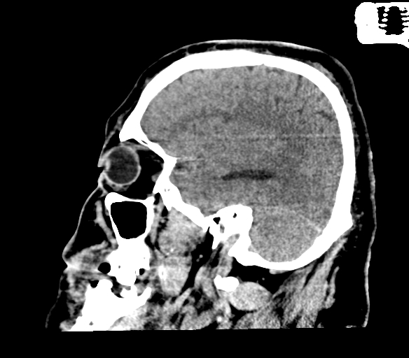 Brainstem hemorrhage (Radiopaedia 81294-94976 C 15).jpg