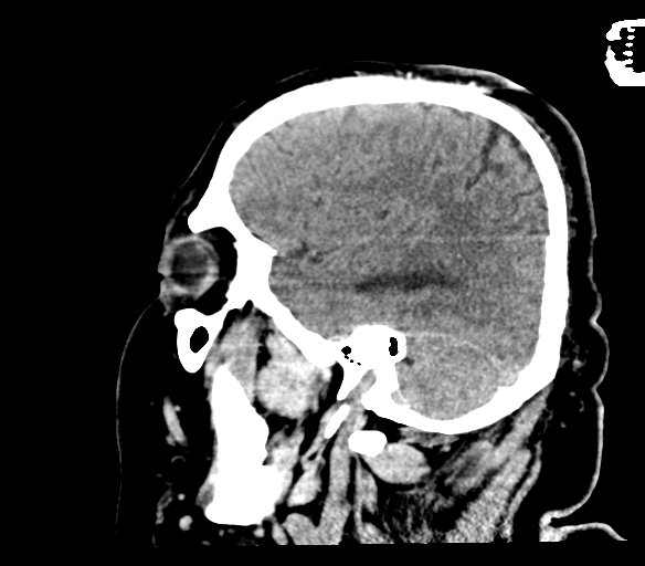 Brainstem hemorrhage (Radiopaedia 81294-94976 C 44).jpg