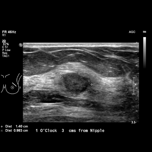 File:Breast metastases from renal cell cancer (Radiopaedia 79220-92226 Left breast US 4).jpeg
