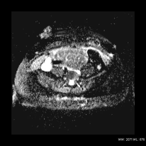 File:Broad ligament fibroid (Radiopaedia 49135-54241 Axial ADC 8).jpg