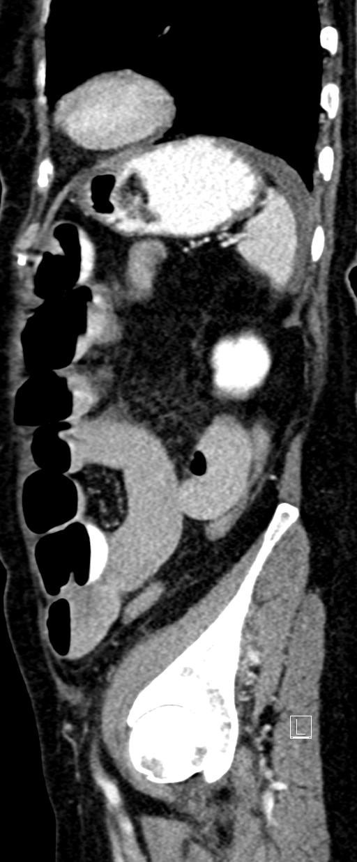 Broad ligament hernia (Radiopaedia 84802-100276 C 14).jpg