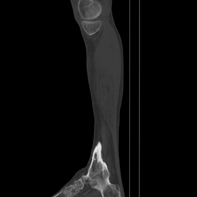 Brodie abscess - tibia (Radiopaedia 66028-75204 Sagittal bone window 5).jpg