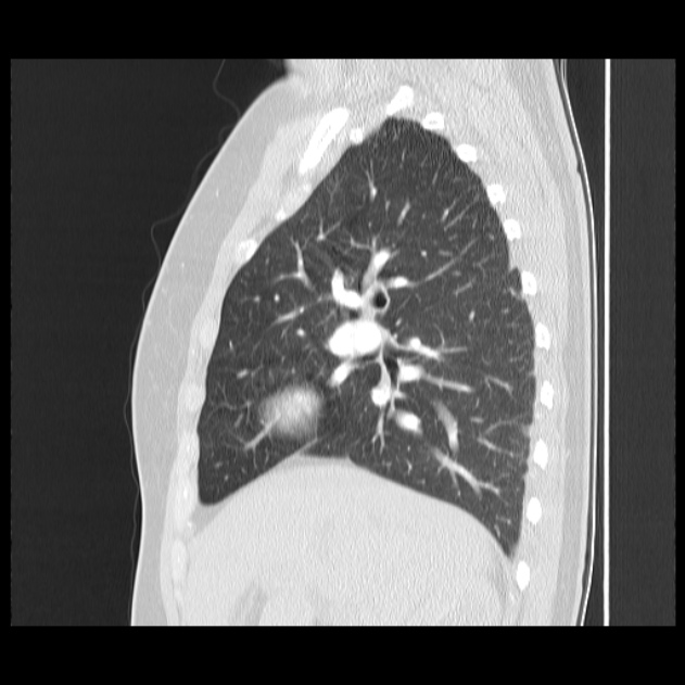 Bronchial atresia (Radiopaedia 22965-22992 Sagittal lung window 36).jpg