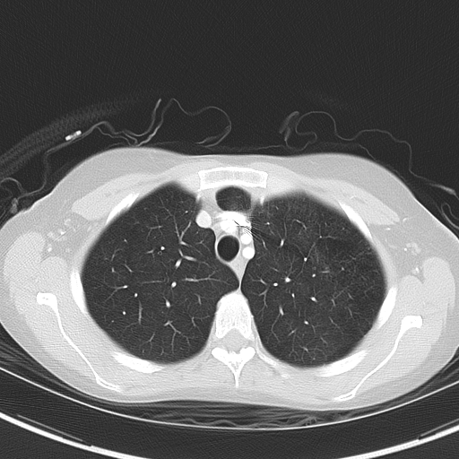 File:Bronchial atresia (Radiopaedia 73677-84470 Axial lung window 16).jpg