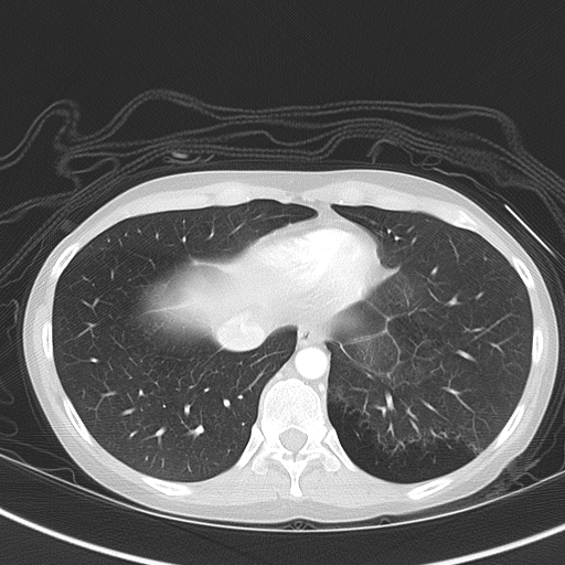 File:Bronchial atresia (Radiopaedia 73677-84470 Axial lung window 47).jpg