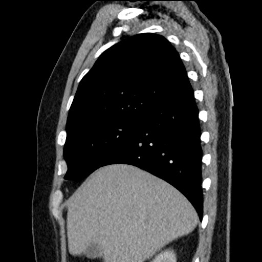 File:Bronchial carcinoid tumor (Radiopaedia 67377-76764 E 17).jpg