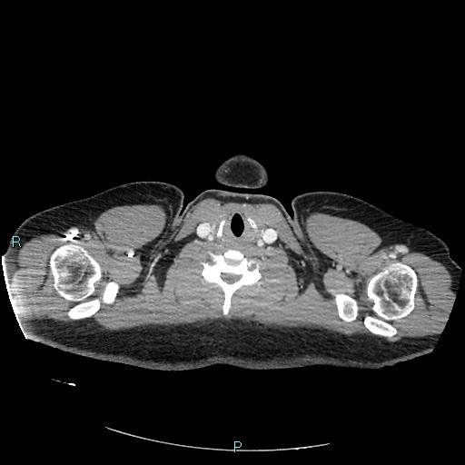 Bronchial carcinoid tumor (Radiopaedia 78272-90875 A 2).jpg
