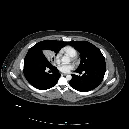 File:Bronchial carcinoid tumor (Radiopaedia 78272-90875 A 54).jpg