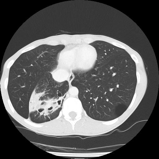 Bronchial carcinoid tumor causing right lower lobe collapse (Radiopaedia 83495-98594 Axial lung window 41).jpg
