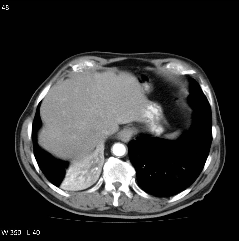 Bronchial carcinoid tumor with right lower lobe collapse (Radiopaedia 29060-29422 A 47).jpg