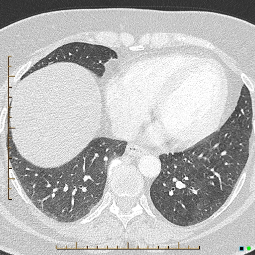 Bronchial diverticula (Radiopaedia 79512-92676 Axial lung window 149).jpg
