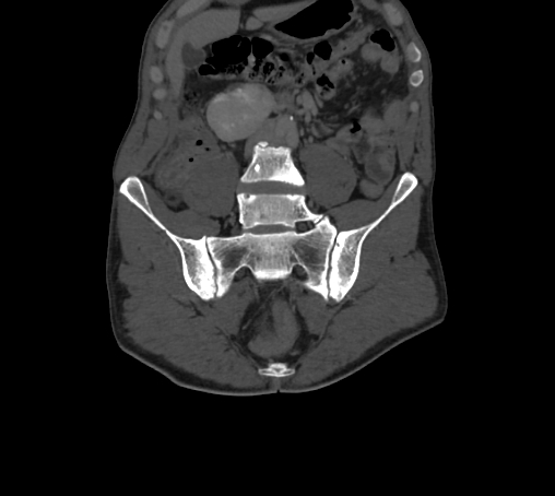 Bronchiectasis in Crohn disease (Radiopaedia 60311-67977 Coronal bone window 23).jpg