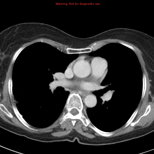 File:Bronchoalveolar carcinoma (BAC) (Radiopaedia 13436-13392 B 27).jpg