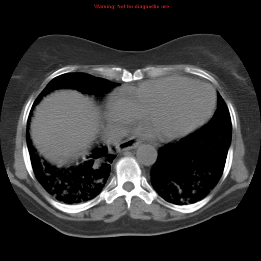 File:Bronchoalveolar carcinoma (Radiopaedia 13224-13233 Axial non-contrast 32).jpg
