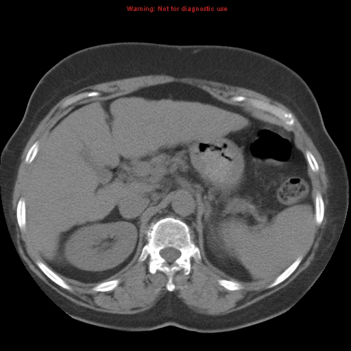 Bronchoalveolar carcinoma (Radiopaedia 13224-13233 Axial non-contrast 50).jpg
