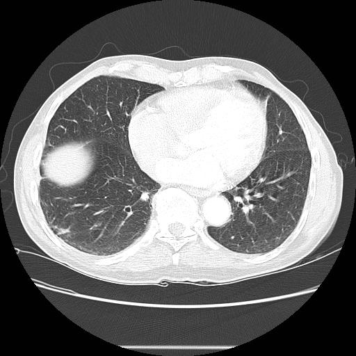 Bronchocele (Radiopaedia 17097-16795 Axial lung window 80).jpg
