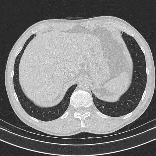 Bronchocele (Radiopaedia 60676-68429 Axial lung window 66).jpg