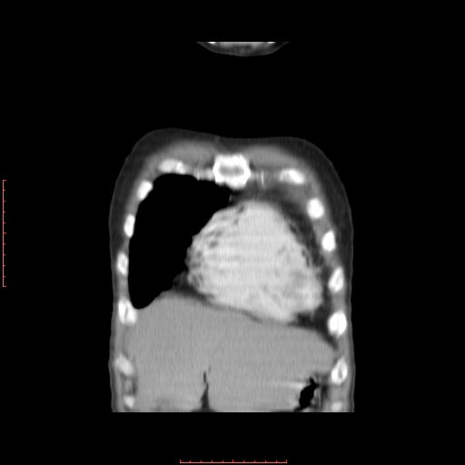 File:Bronchogenic carcinoma with left atrial large deposit - T4N3M1a (Radiopaedia 42316-45428 B 2).jpg