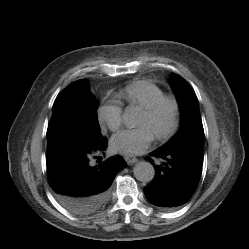 Bronchogenic carcinoma with metastatic lymphadenopathy (Radiopaedia 37671-39569 Axial non-contrast 34).jpg
