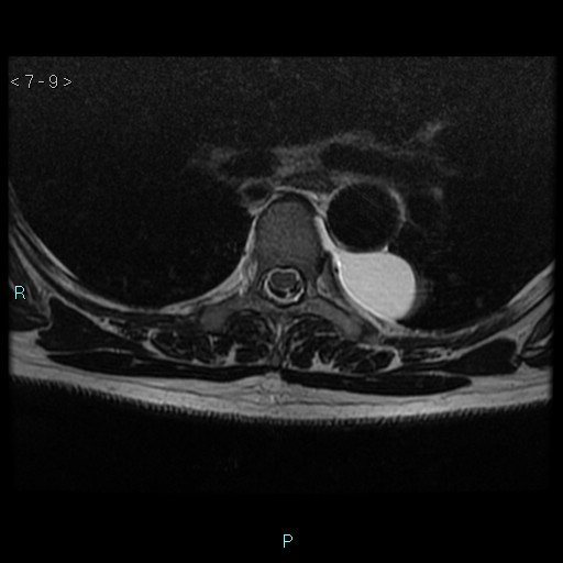 File:Bronchogenic cyst - posterior mediastinal (Radiopaedia 43885-47365 Axial T2 9).jpg