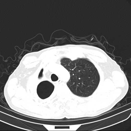 Bronchopleural fistula - postoperative complication (Radiopaedia 21020-20947 Axial lung window 13).jpg