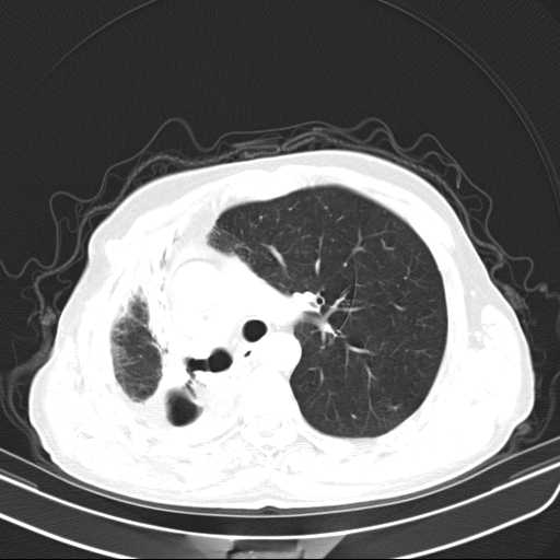 Bronchopleural fistula - postoperative complication (Radiopaedia 21020-20947 Axial lung window 21).jpg