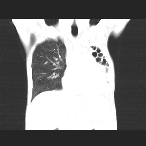 File:Bronchopleural fistula secondary to tuberculosis (Radiopaedia 20415-20322 Coronal lung window 8).jpg